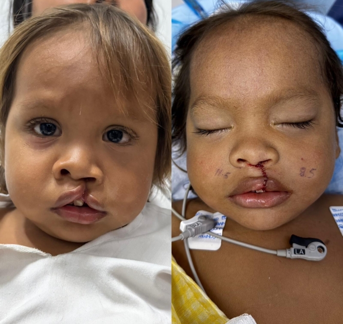 2024 Santa Marta Before & After